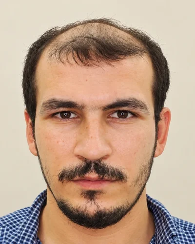 Saç ekimi öncesi