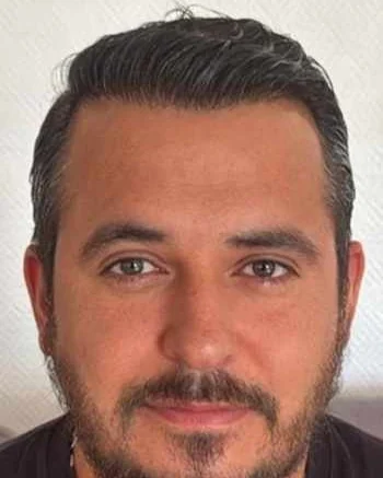 Daniel K. saç ekimi sonrası