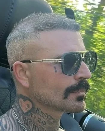 Paul D. saç ekimi sonrası